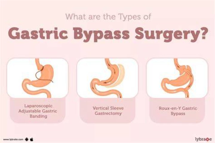 Are gastric bypasses safe?