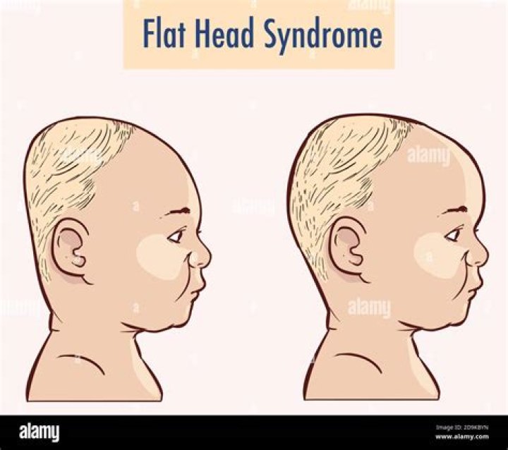 Whats flat head syndrome?