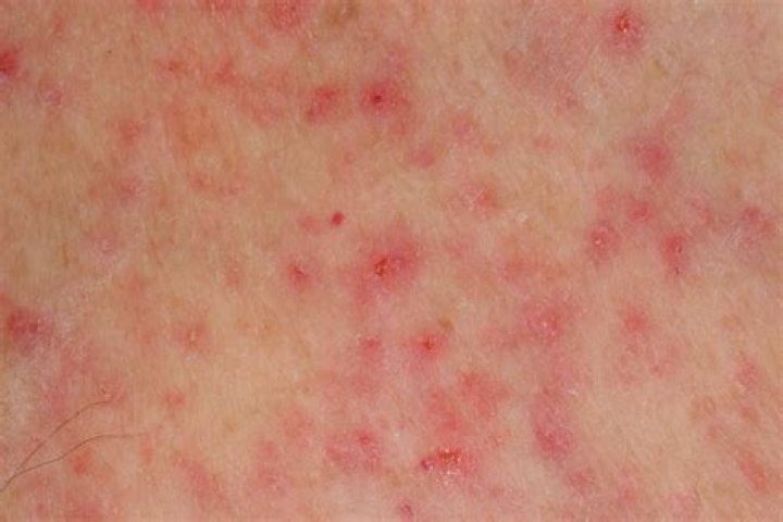 Where do skin blotches come from?