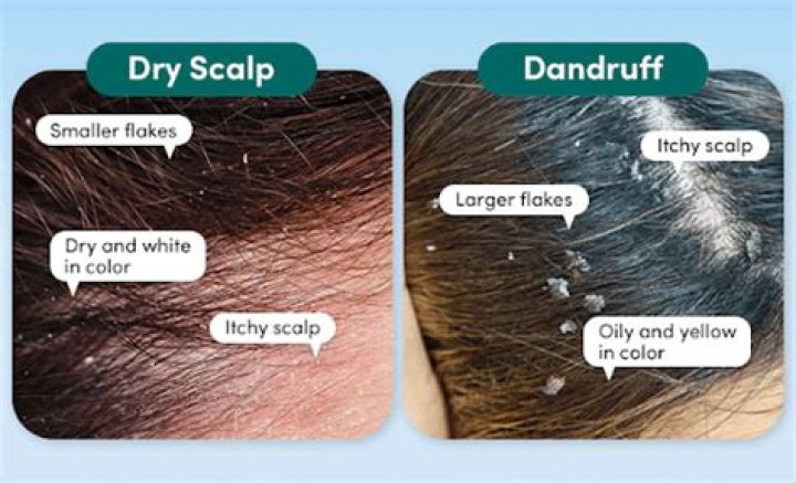 Will coconut oil help dry scalp?